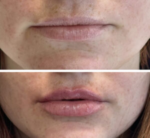 Before After lip filler Restylane Kysse | Thrive Medical Spa Milton, GA