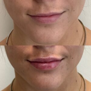 Before After lip filler | Thrive Medical Spa Milton, GA
