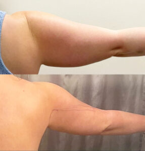 Arm Lipo Before and After | Thrive Medical Spa Milton, GA