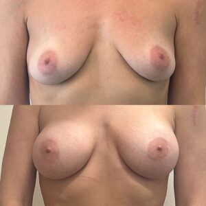 Breast Augmentation Before and After | Thrive Medical Spa Milton, GA
