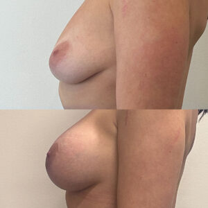 Breast Augmentation Before and After | Thrive Medical Spa Milton, GA