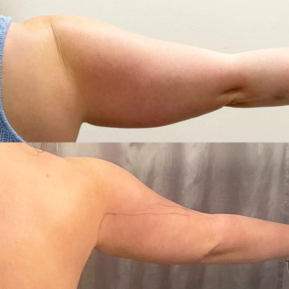Arm Lipo Before and After | Thrive Medical Spa Milton, GA